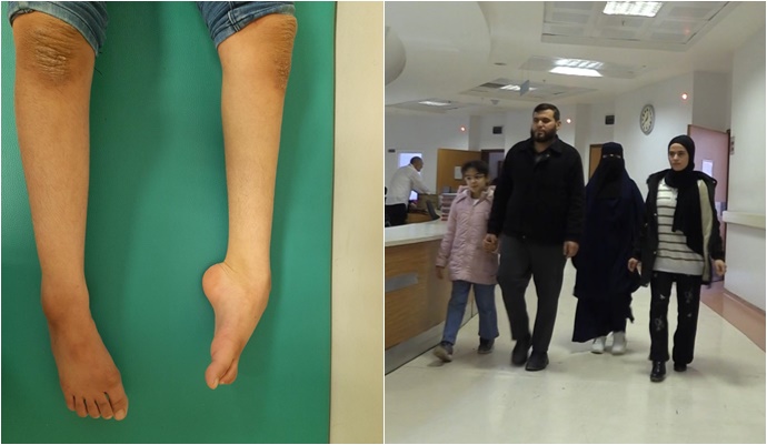 Şanlıurfa’da Milyonda Bir Görülen Hastalıkta Mucize: 3 Kardeş Yürümeye Başladı-(VİDEO)