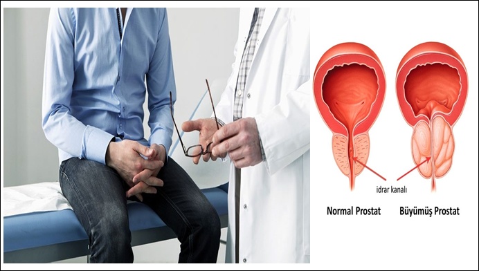 40 Yaşından Sonra Erkeklerin Ortak Sorunu: Prostat Büyümesi
