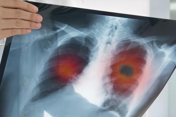 Akciğer kanserinde en önemli risk faktörü tütün kullanımı