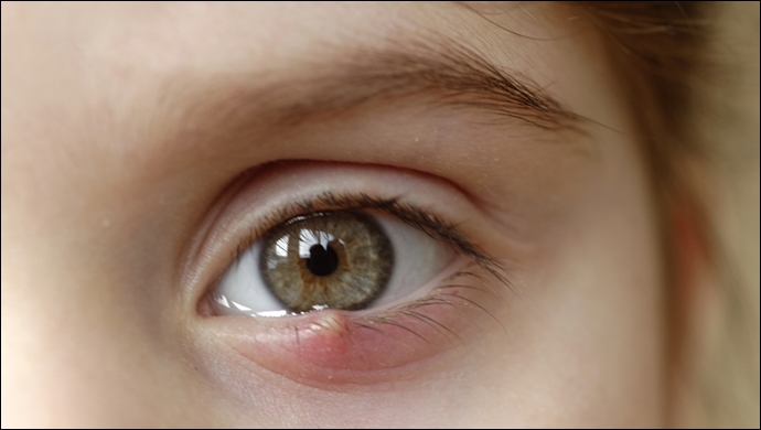 Dikkat! Tedavide sarımsağın yeri yok!